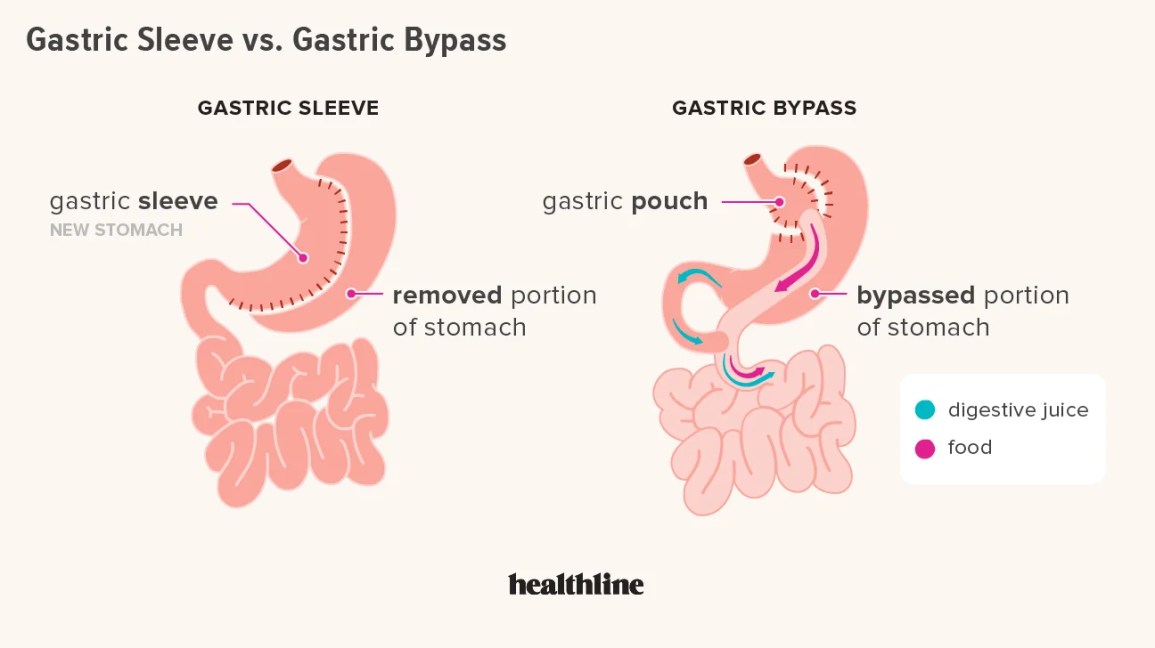 7 Weight Loss Surgery Types: Finding Your Best Option