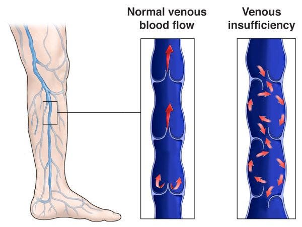 Illustration of a leg affected by Chronic Venous Insufficiency showing visible vein issues and swelling.