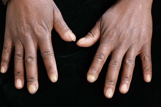 Close-up of fingers on a dark-skinned hand showing pale, bloodless tips characteristic of a Raynaud's flare-up.