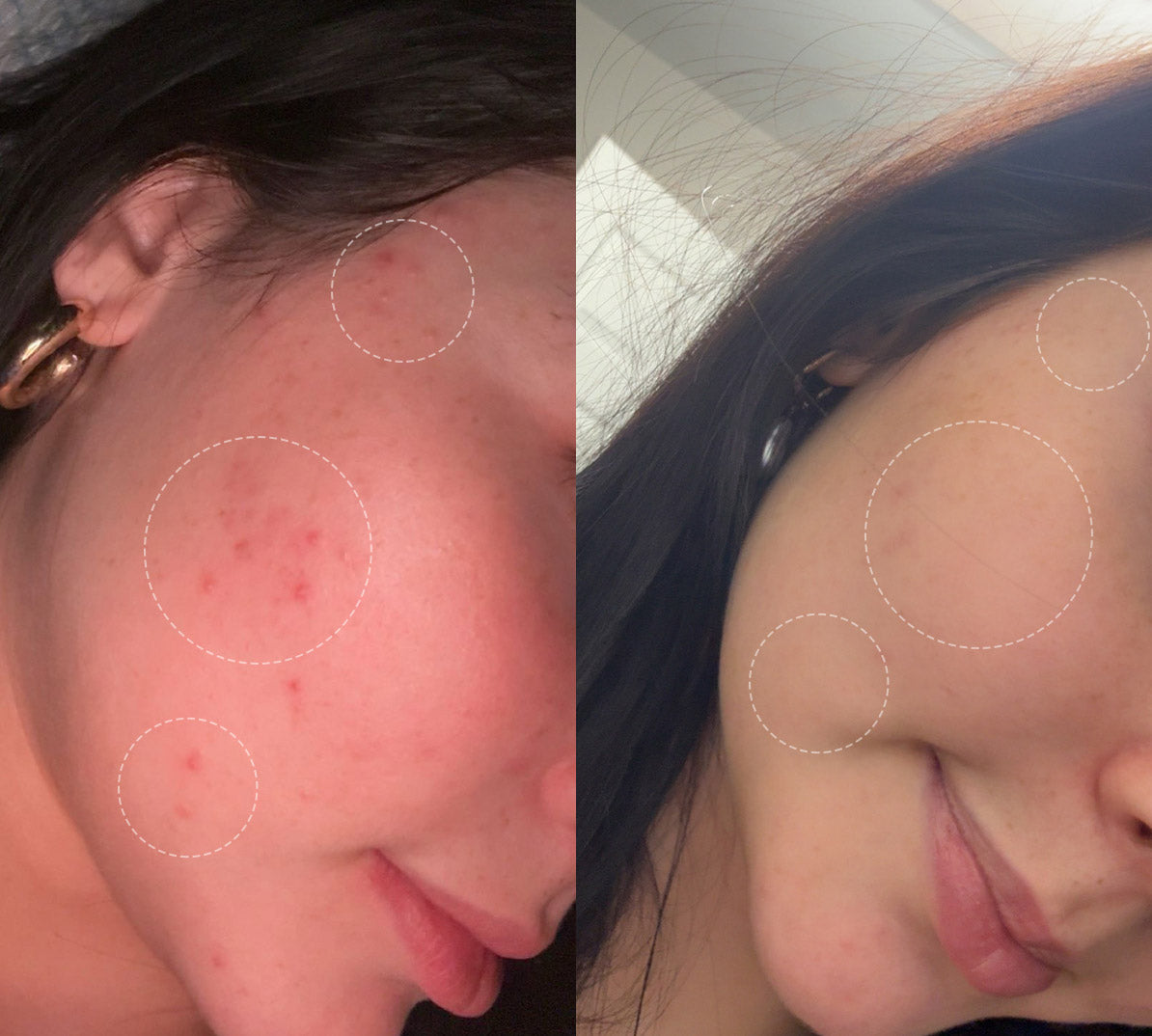 Split screen showing before and after comparison of skin texture and clarity after light therapy.