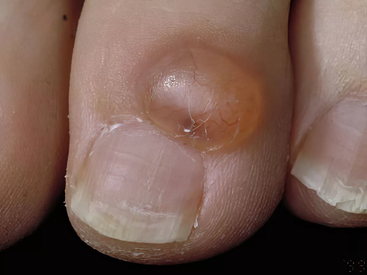Close-up clinical photo of a myxoid cyst on the toe of a diabetic patient.