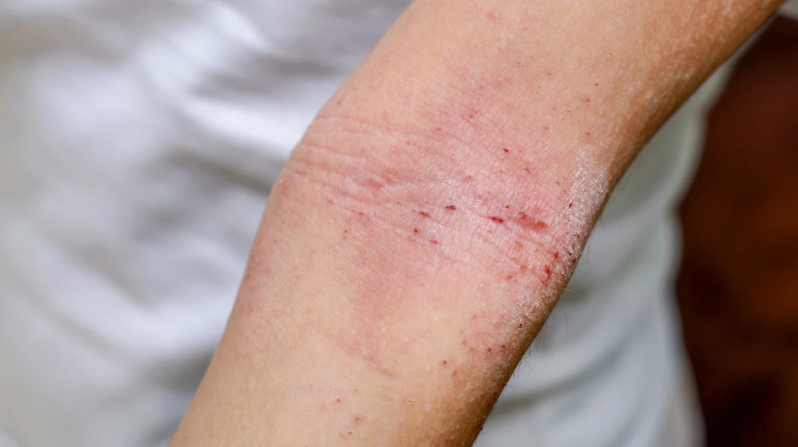 Close-up of a person's arm showing red, scaly, and inflamed eczema patches.