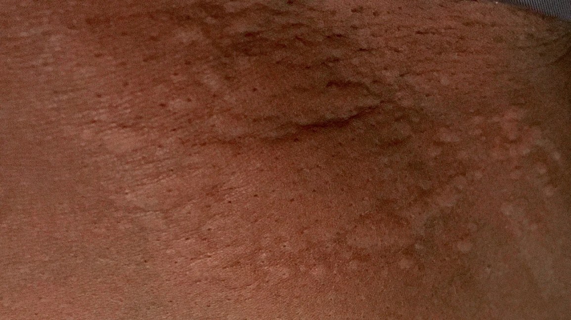 A person with darker skin tone showing raised hives and inflammation on their arm.