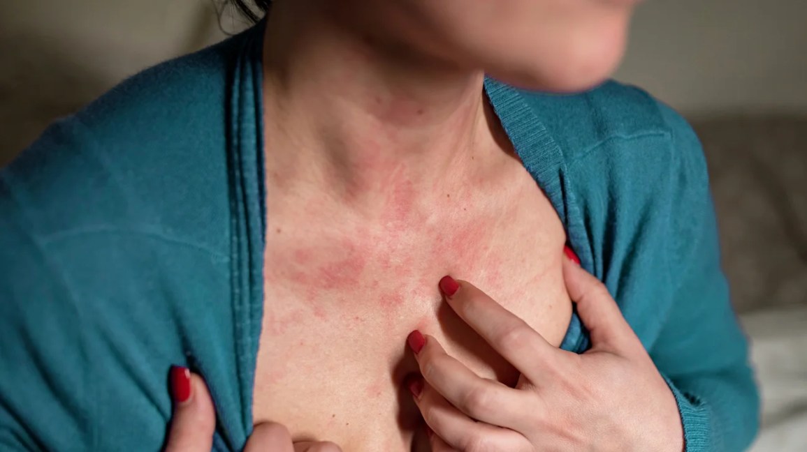 Managing Food Allergy Rash: The Big Eight Triggers