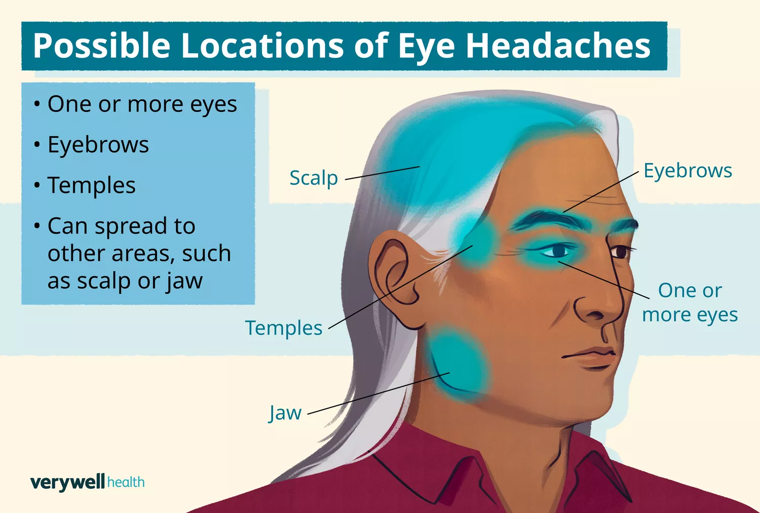 An anatomical diagram highlighting different areas around the eyes and forehead where headache pain is typically felt.